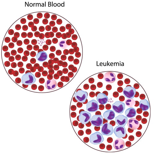 Blood Cancer Cell Image