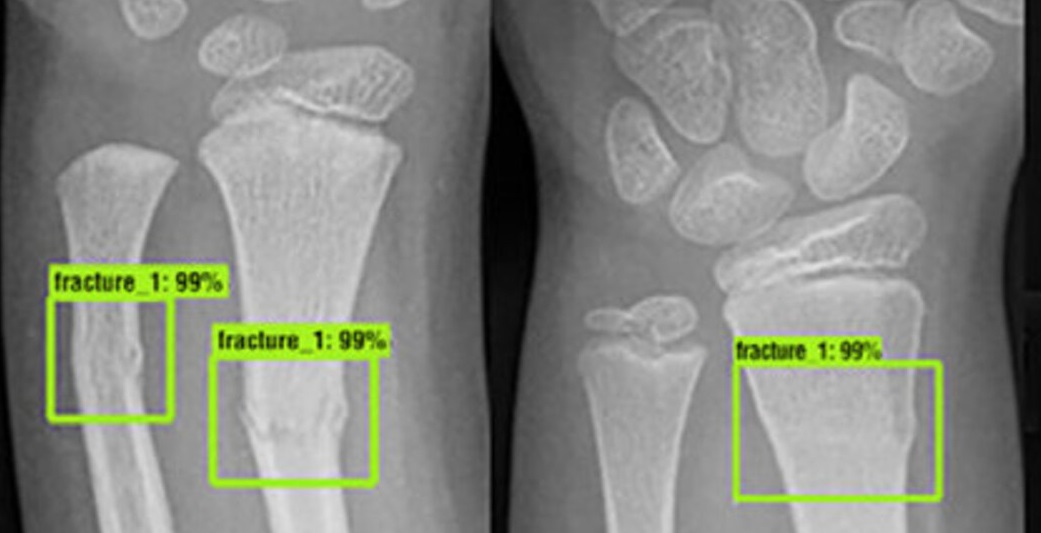 Bone Fracture Image