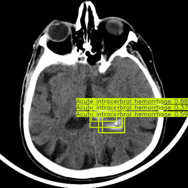 Brain Stroke Image