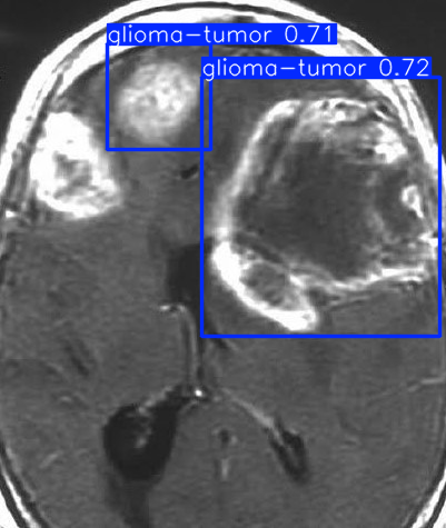 Brain Tumor Image