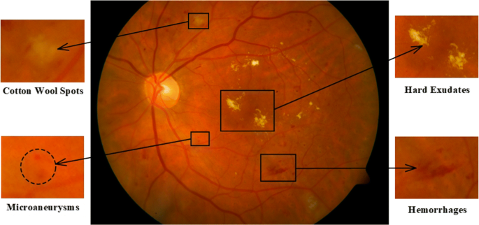 Eye Fundus Image