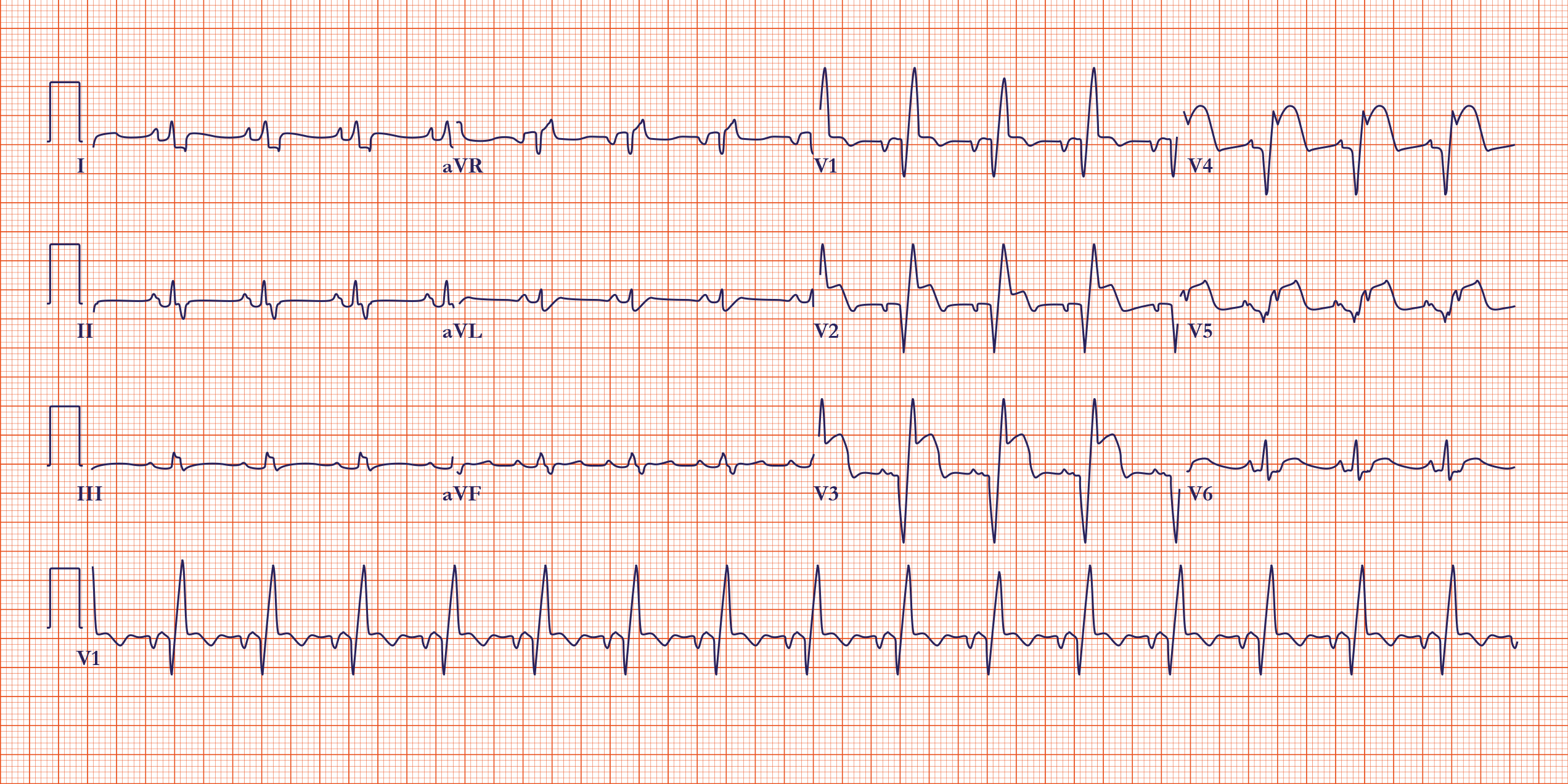 Heart Attack ECG Image