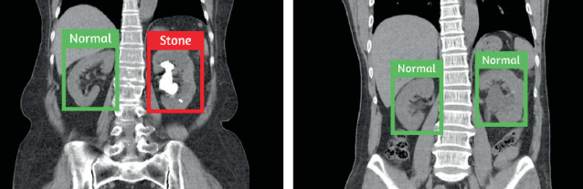 Kidney Stone Image