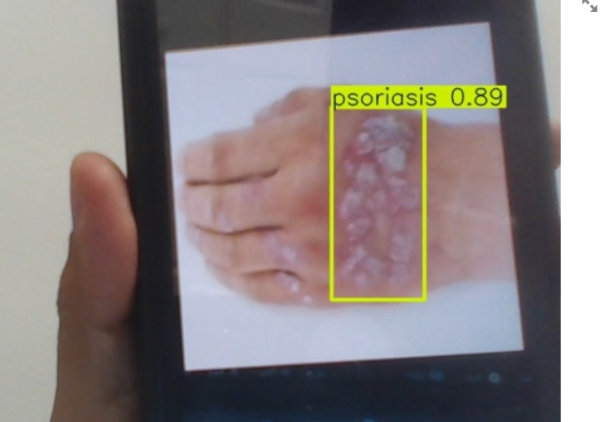 Real-time Skin Disease Detection