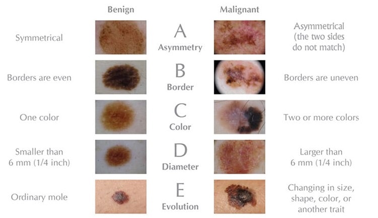 Skin Cancer Image