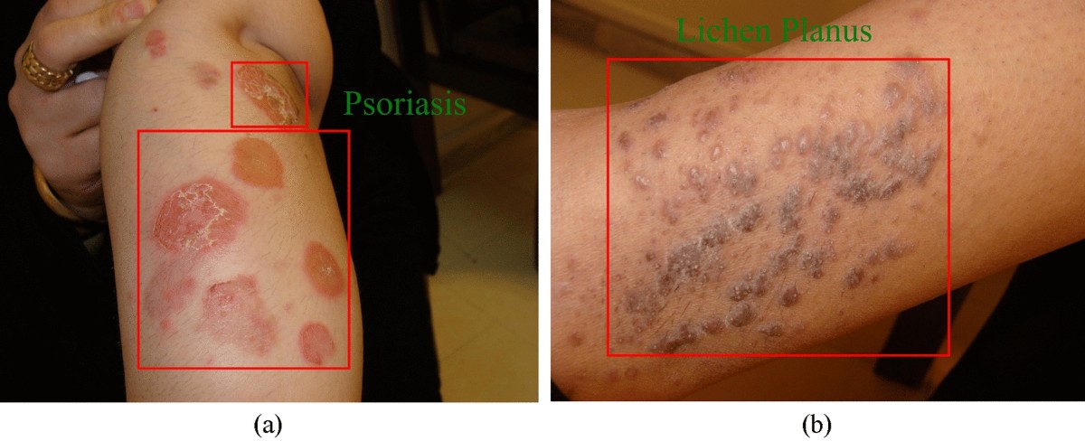 Skin Disease Image